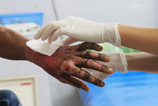burn patient